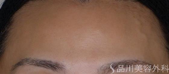 症例NO.50060のBEFORE写真