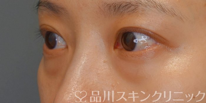 症例NO.74081のBEFORE写真