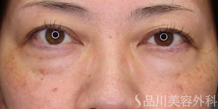症例NO.75172のBEFORE写真