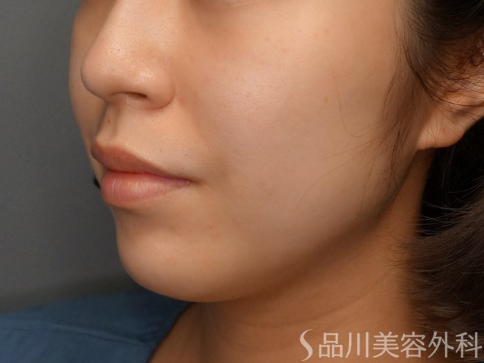 症例NO.74928のBEFORE写真