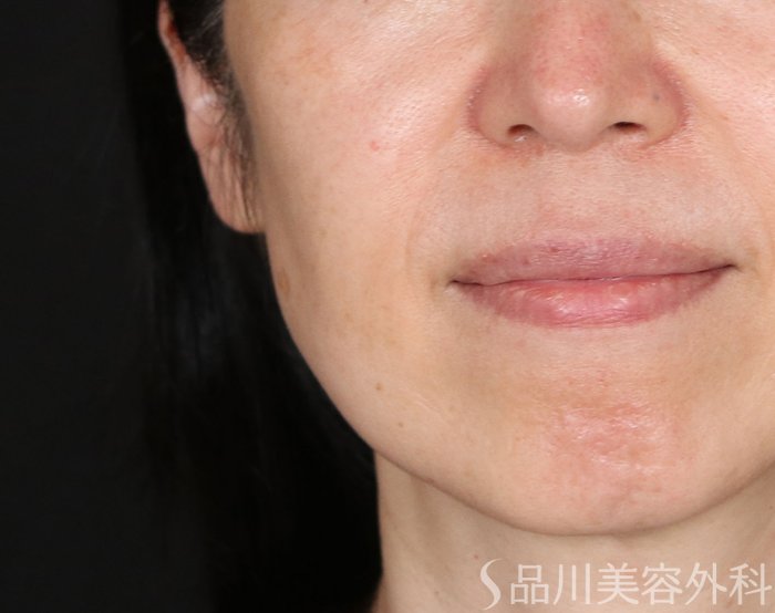 症例NO.71316のBEFORE写真