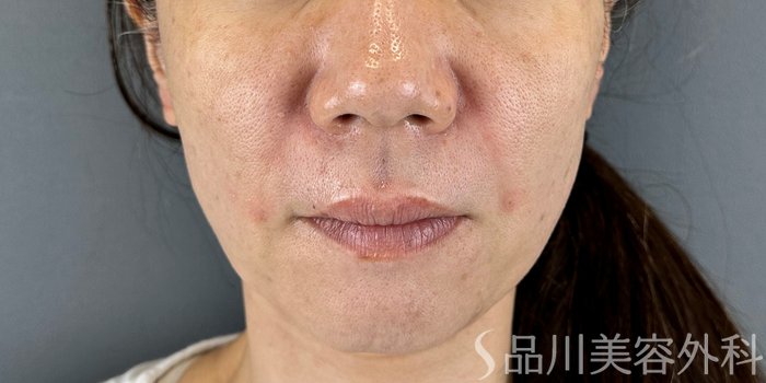症例NO.71522のAFTER写真