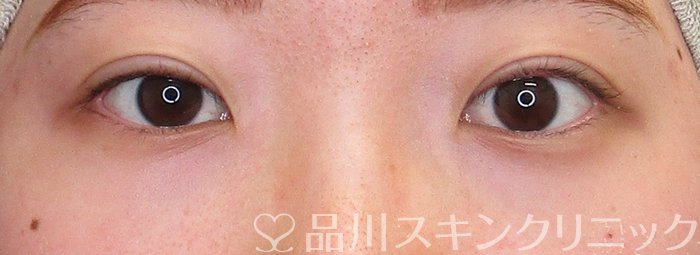 症例NO.74664のAFTER写真