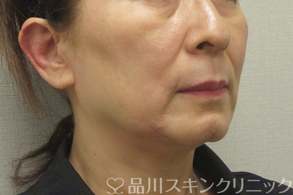 症例NO.74202のBEFORE写真