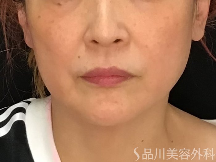 症例NO.69985のBEFORE写真