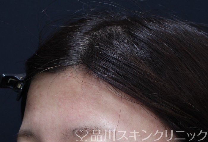 症例NO.63936のBEFORE写真