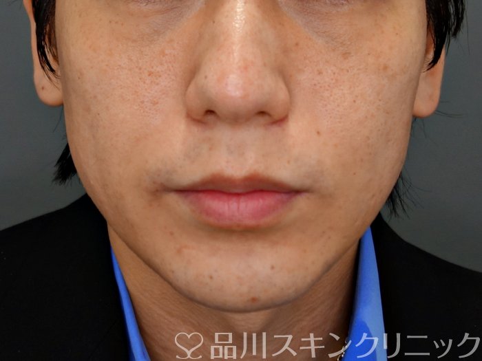 症例NO.73823のBEFORE写真