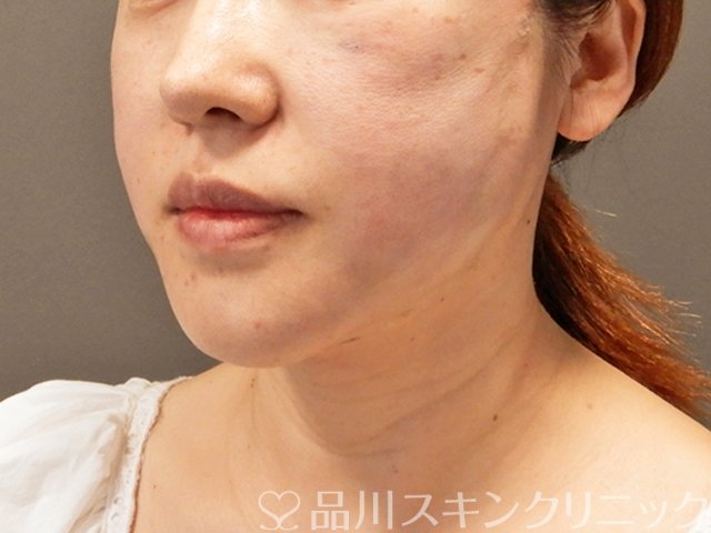 症例NO.70932のAFTER写真