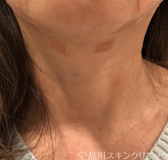 症例NO.32830のAFTER写真