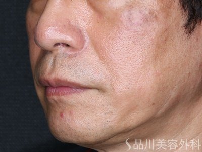 症例NO.74292のBEFORE写真