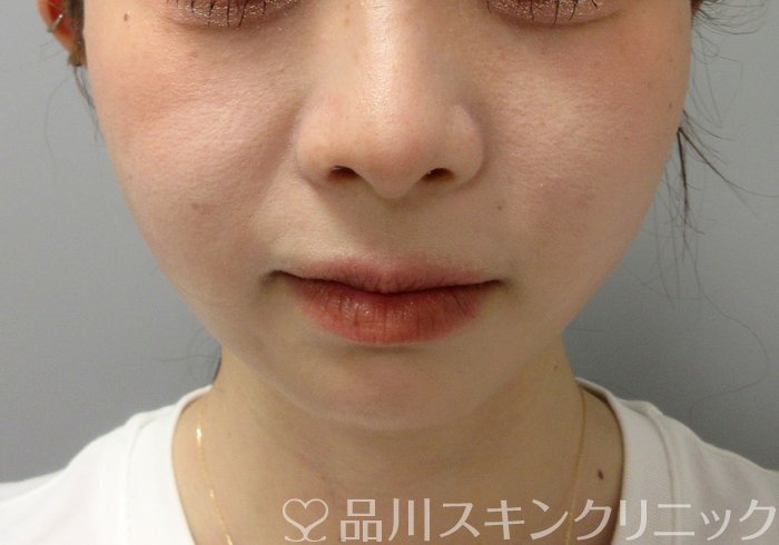 症例NO.73545のAFTER写真