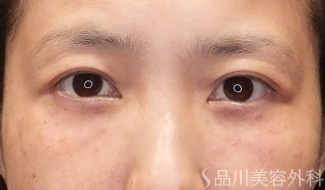 症例NO.75041のAFTER写真