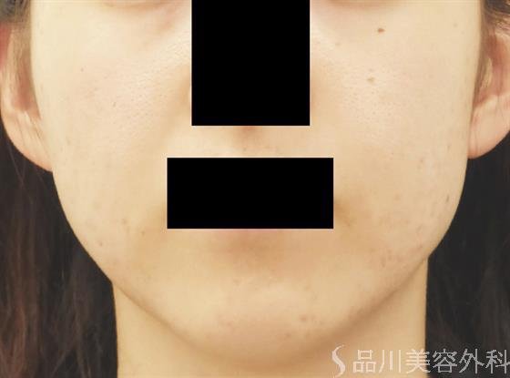 症例NO.24284のAFTER写真