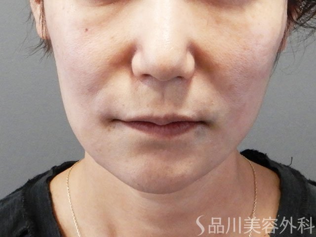 症例NO.71955のAFTER写真