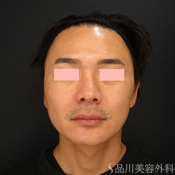 症例NO.69475のBEFORE写真