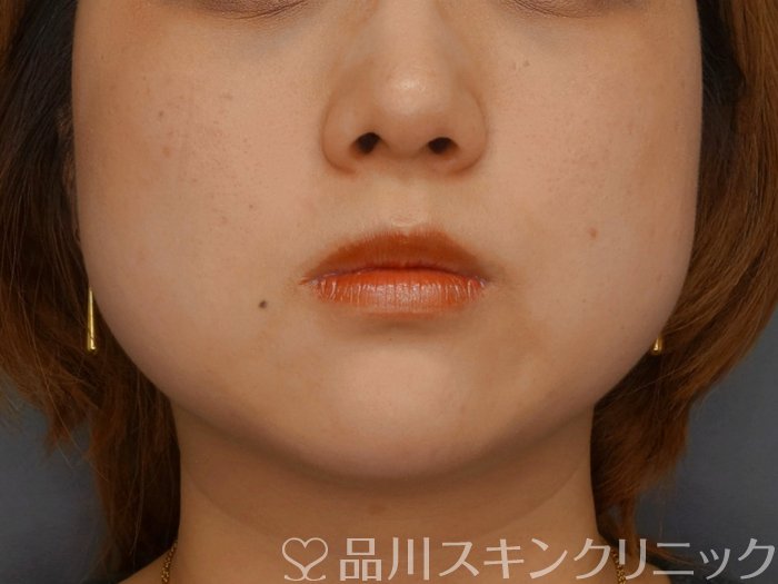 症例NO.74129のBEFORE写真