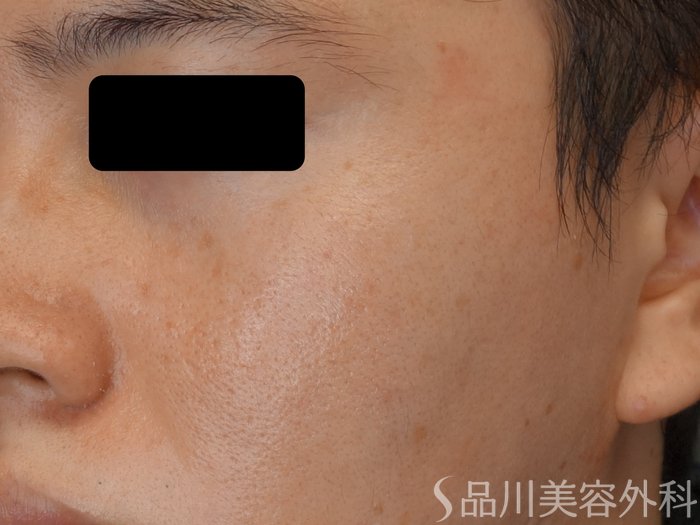 症例NO.72449のAFTER写真