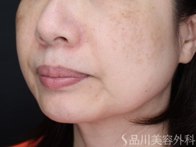 症例NO.71370のBEFORE写真