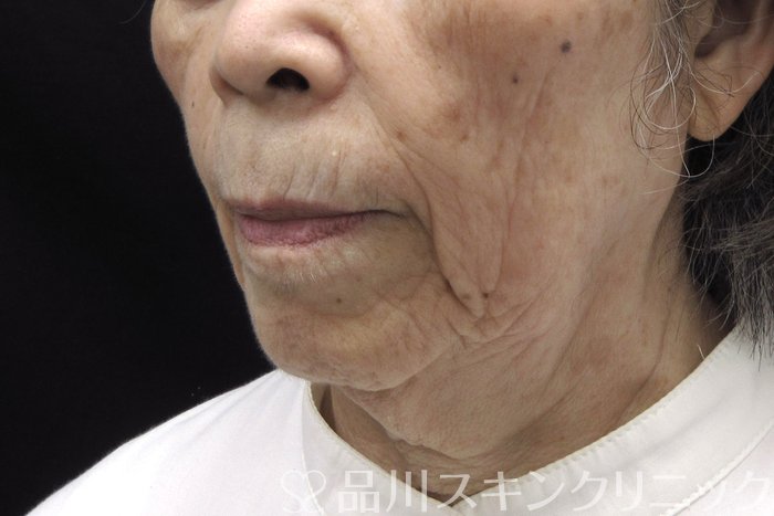 症例NO.74398のBEFORE写真