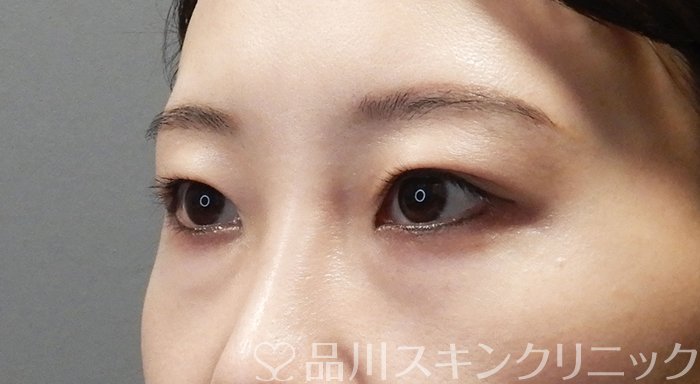 症例NO.72190のBEFORE写真