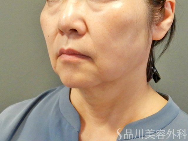 症例NO.67754のAFTER写真