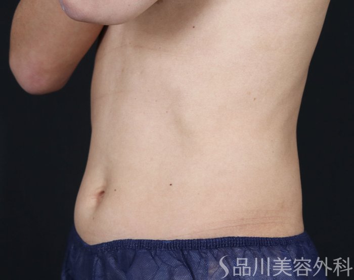 症例NO.73143のAFTER写真