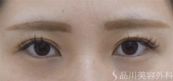 症例NO.55718のAFTER写真