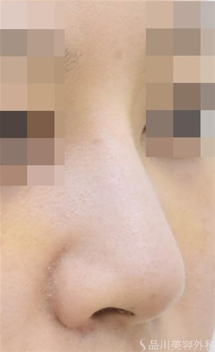 症例NO.42880のAFTER写真