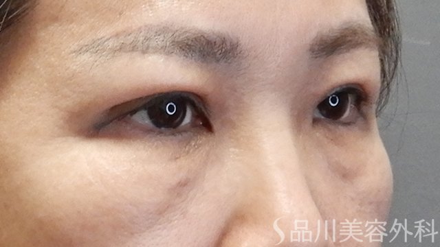症例NO.68686のAFTER写真