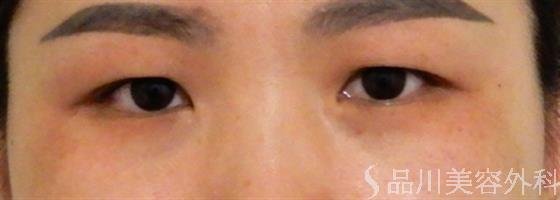 症例NO.38408のBEFORE写真
