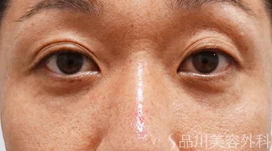 症例NO.71142のAFTER写真