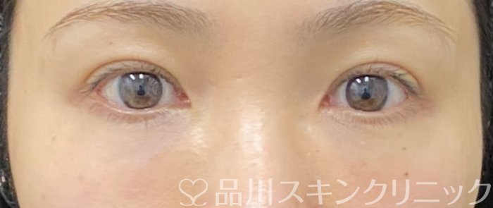 症例NO.75164のAFTER写真