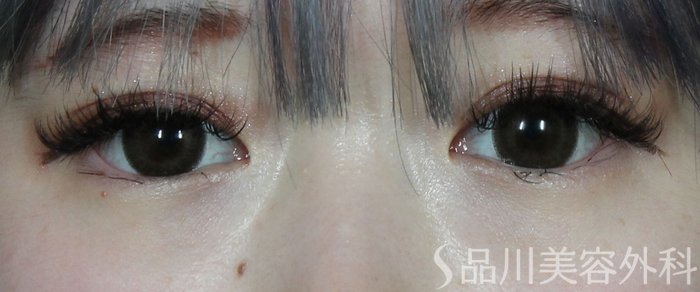 症例NO.73391のBEFORE写真