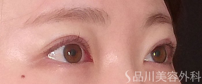 症例NO.70990のAFTER写真