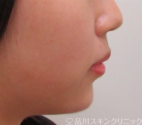 症例NO.30724のAFTER写真
