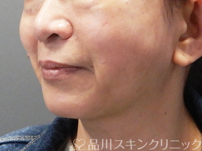 症例NO.73522のAFTER写真