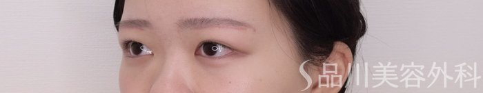 症例NO.69372のAFTER写真
