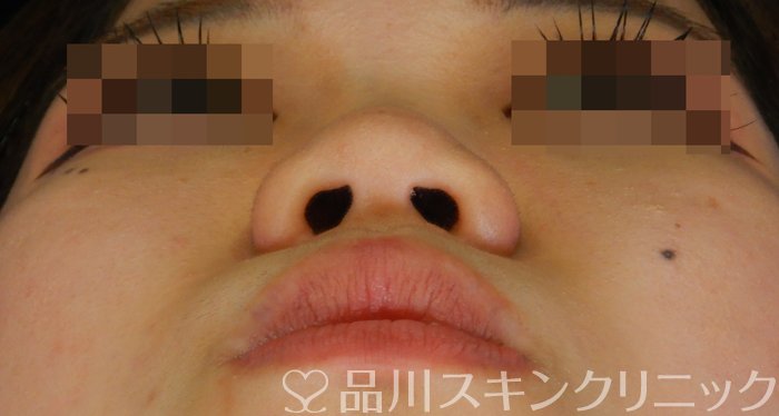 症例NO.65746のBEFORE写真