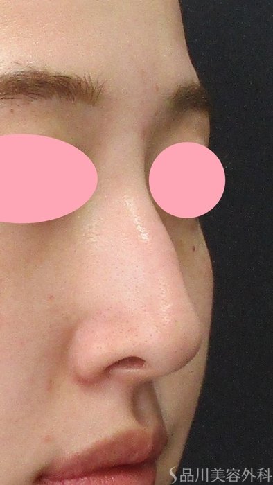 症例NO.74114のAFTER写真