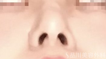 症例NO.64942のAFTER写真