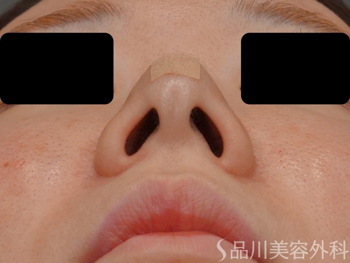 症例NO.63520のAFTER写真