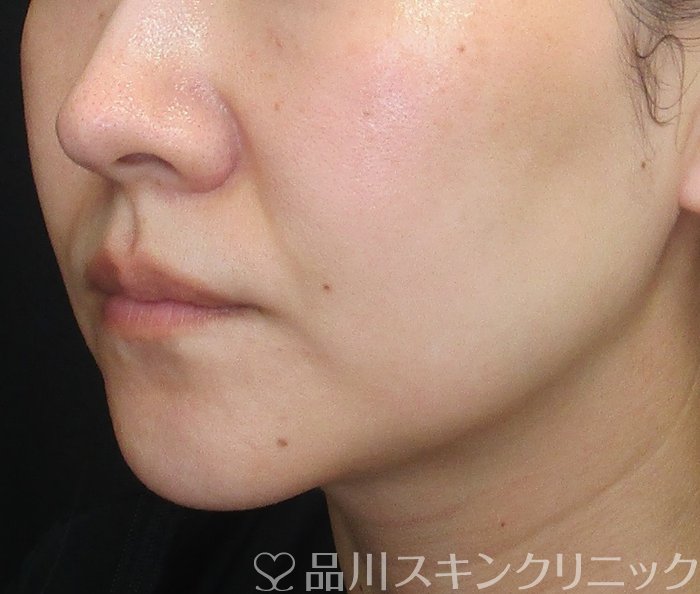 症例NO.72775のAFTER写真