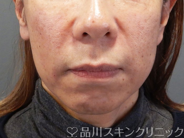 症例NO.72336のAFTER写真