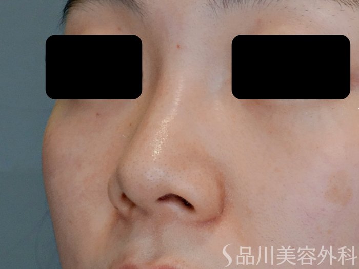 症例NO.71152のBEFORE写真