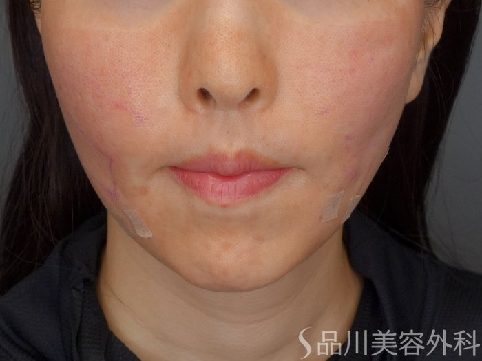 症例NO.73030のAFTER写真