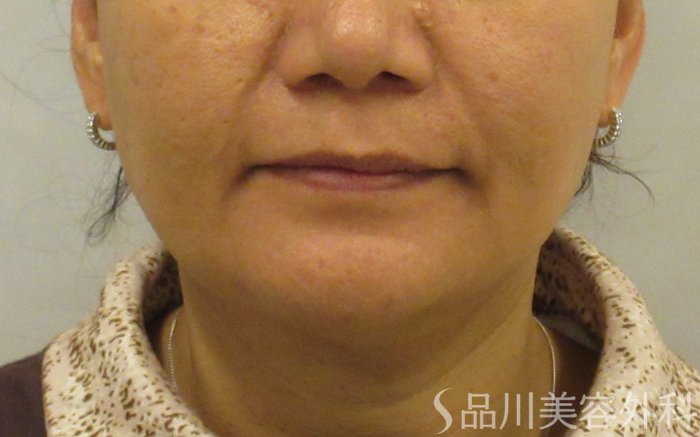 症例NO.73123のBEFORE写真