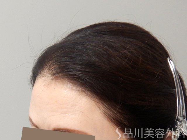 症例NO.70455のAFTER写真
