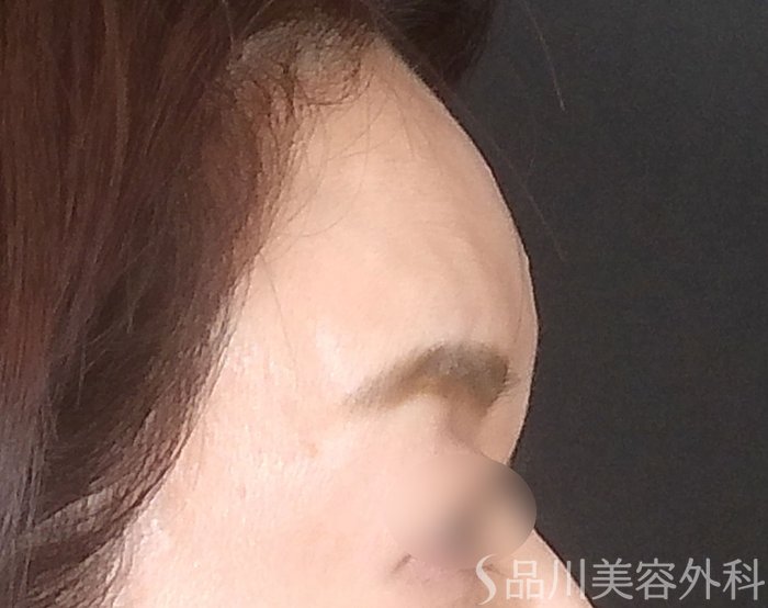 症例NO.67645のBEFORE写真