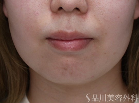 症例NO.70670のBEFORE写真
