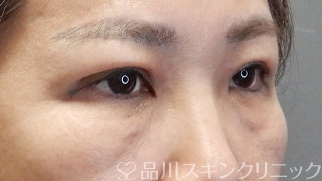 症例NO.68686のAFTER写真